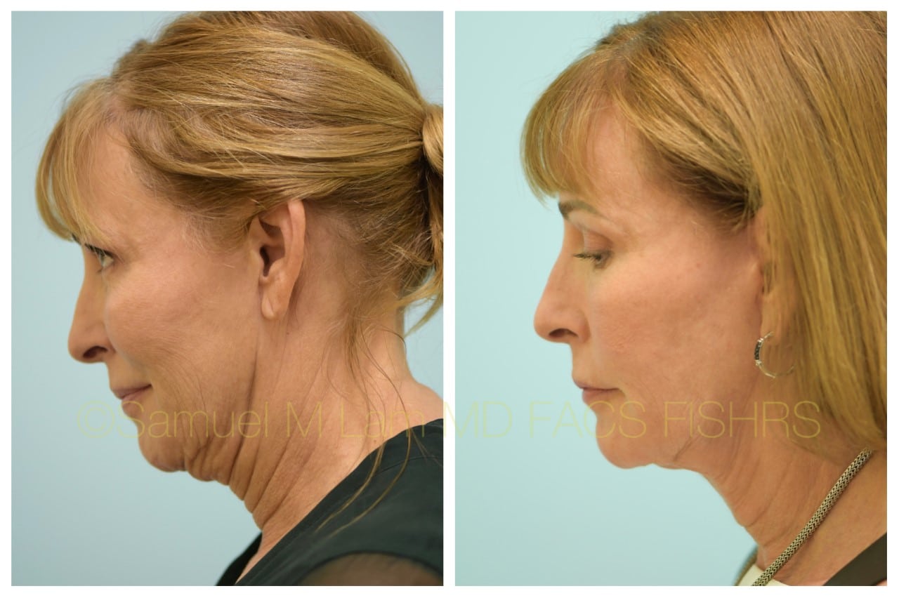 facelfit