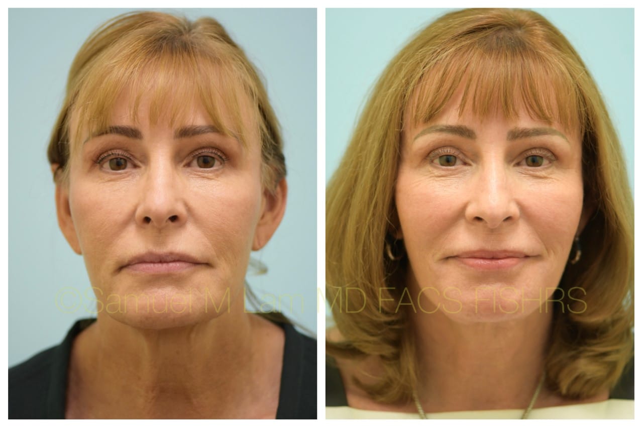 facelift