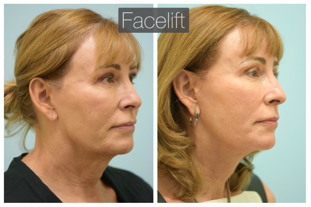 facelift