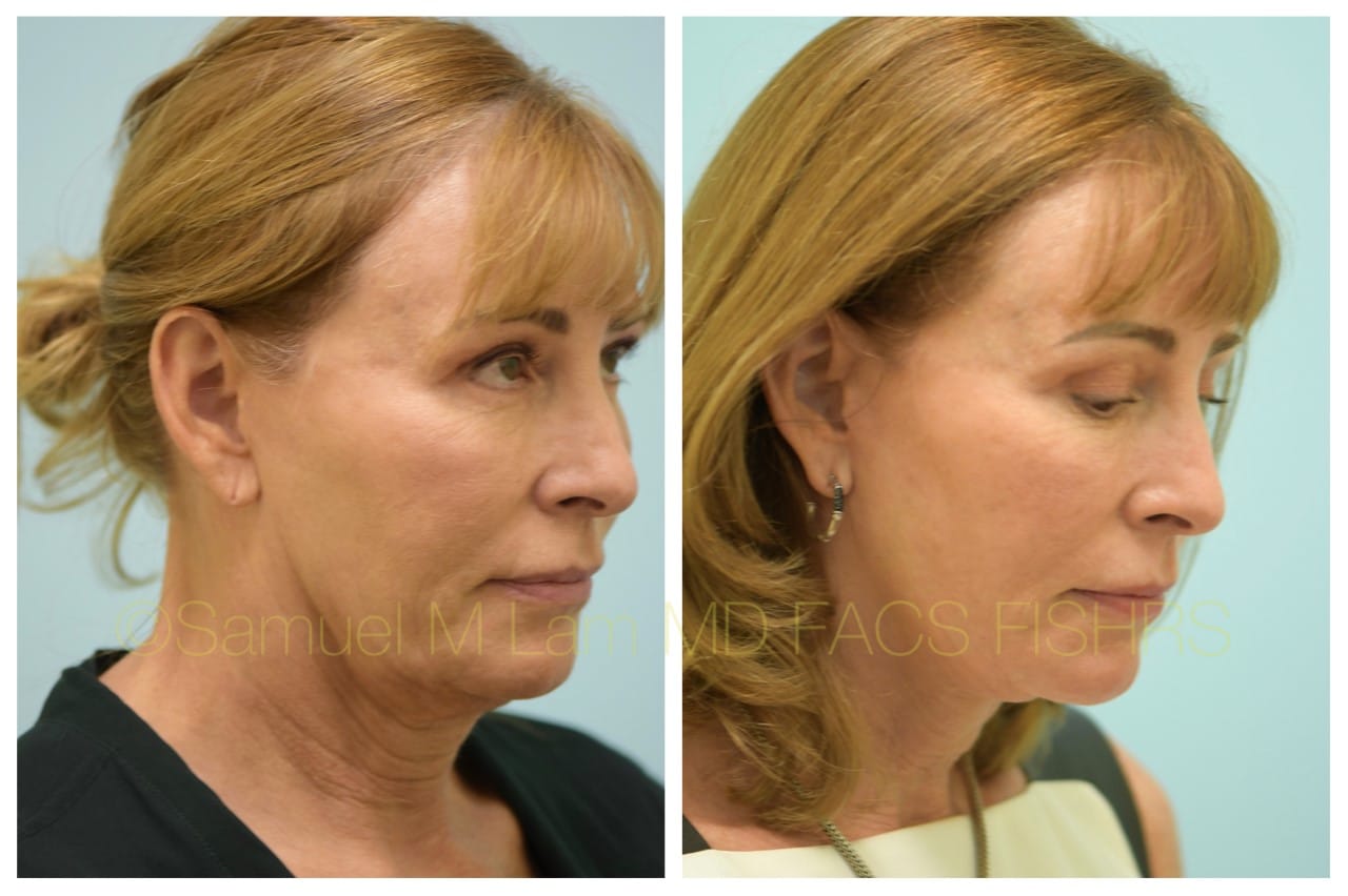 facelift