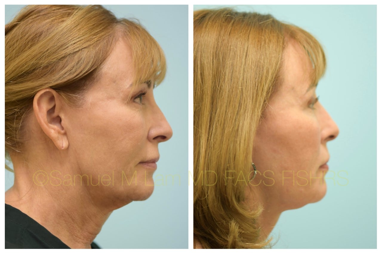 facelift