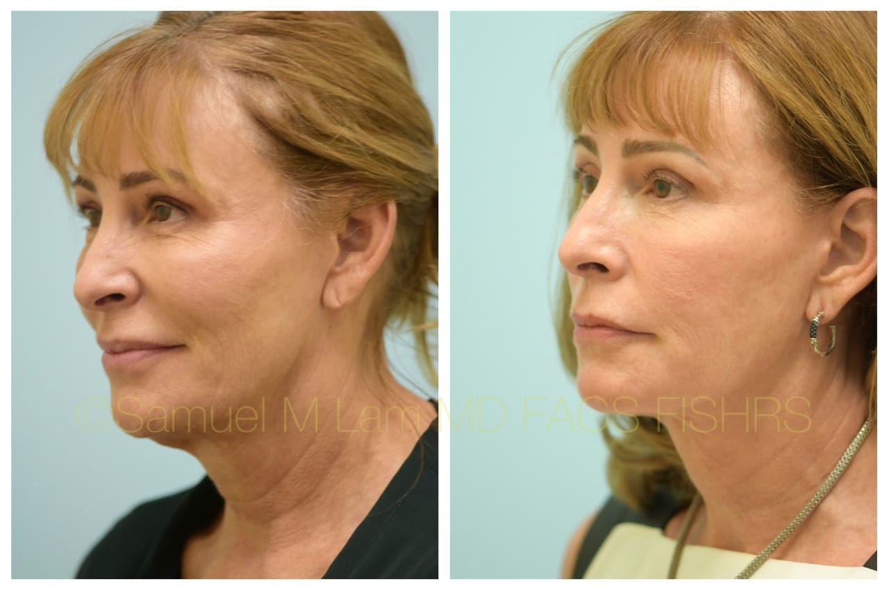 facelift
