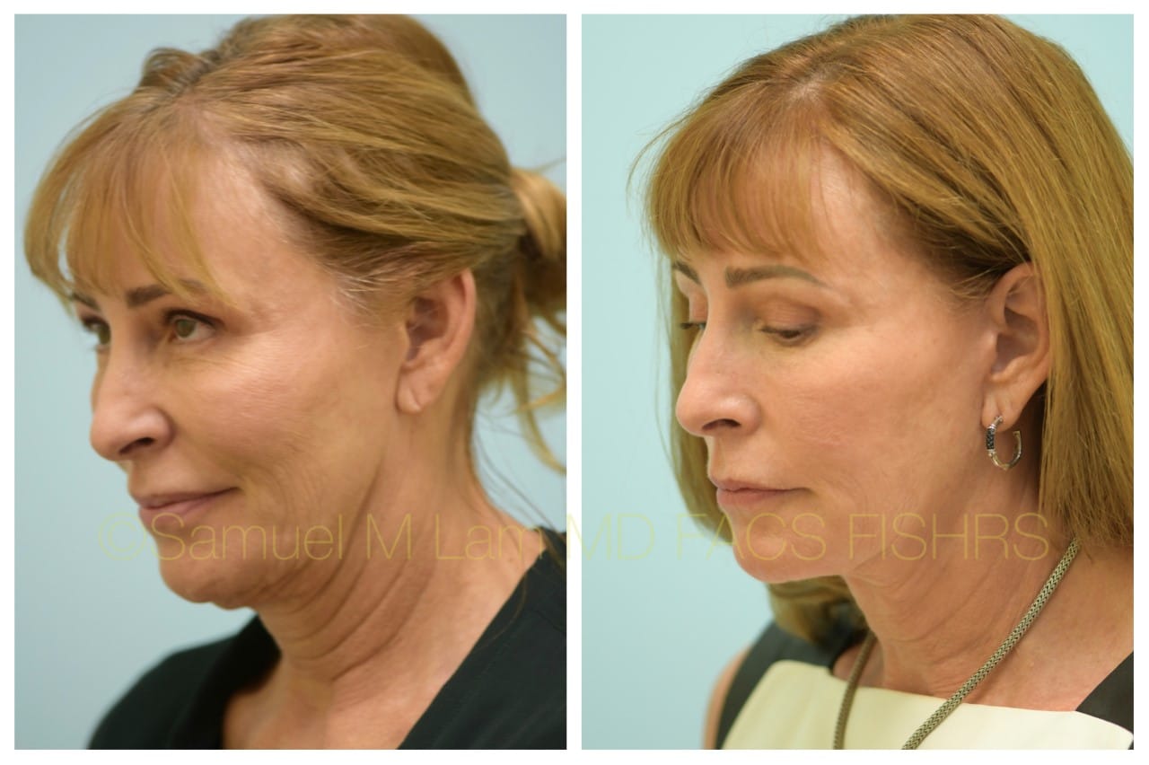facelift