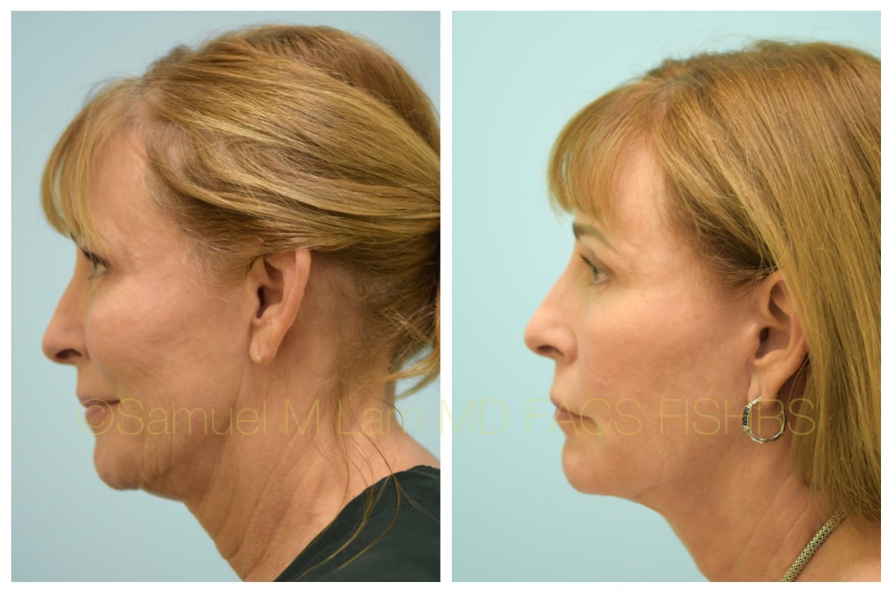 facelift