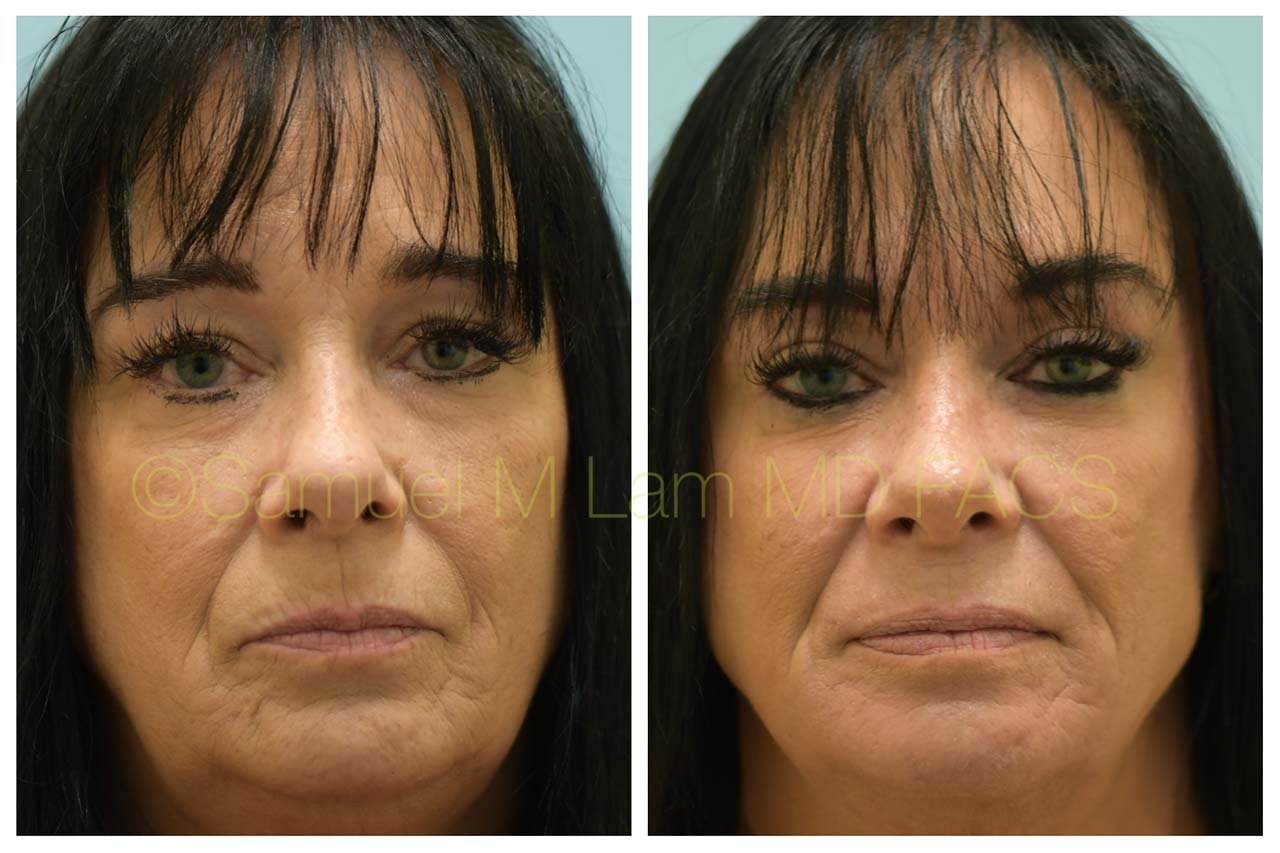 laser treatments of