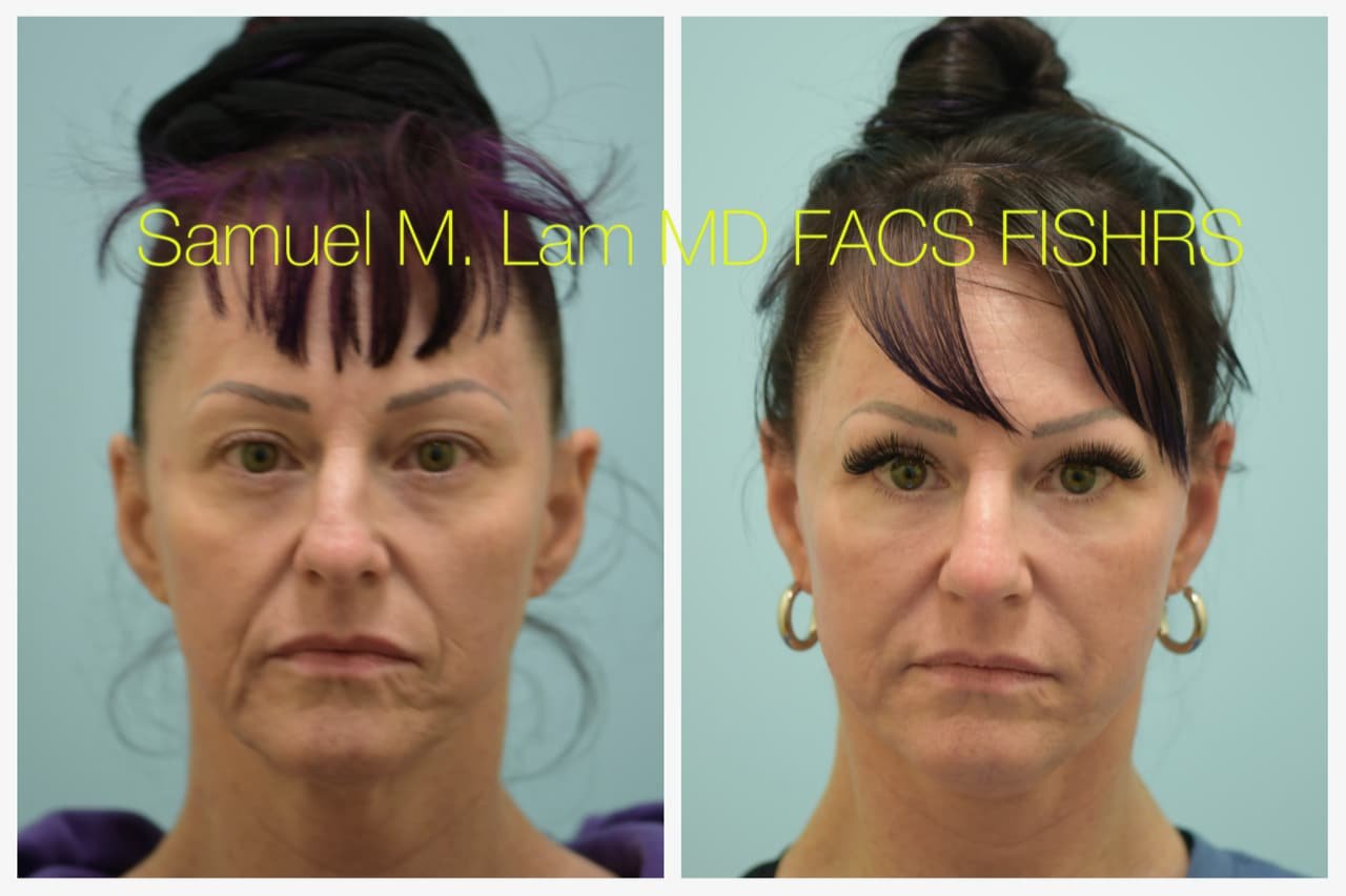 Rhinoplasty Before and After Photo by Dr. Lam in Plano TX
