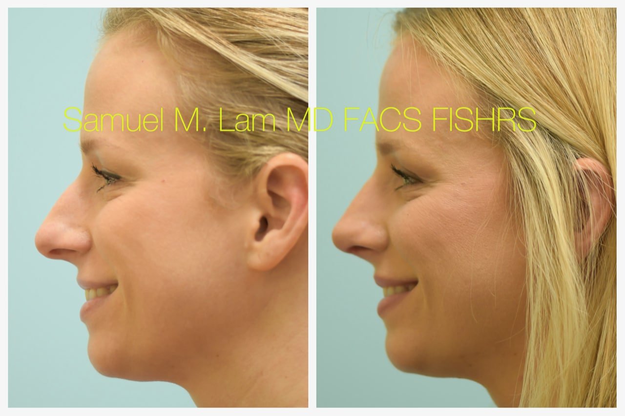 rhinoplasty-10of11-42623 Rhinoplasty Before and After Photo by Dr. Lam in Plano TX