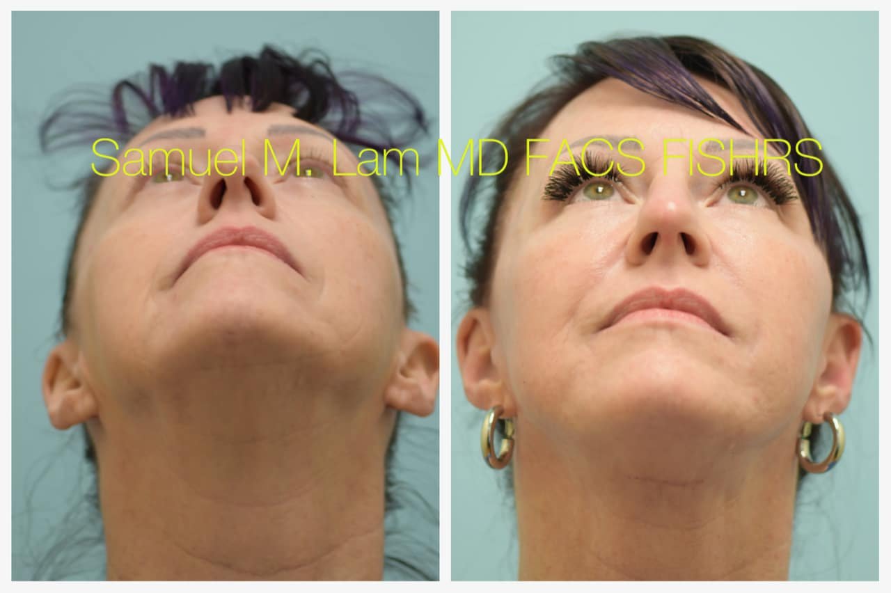 Rhinoplasty Before and After Photo by Dr. Lam in Plano TX