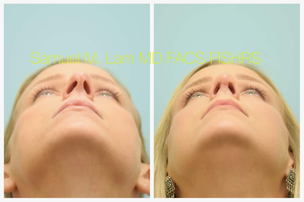rhinoplasty-11of11-42623 Rhinoplasty Before and After Photo by Dr. Lam in Plano TX