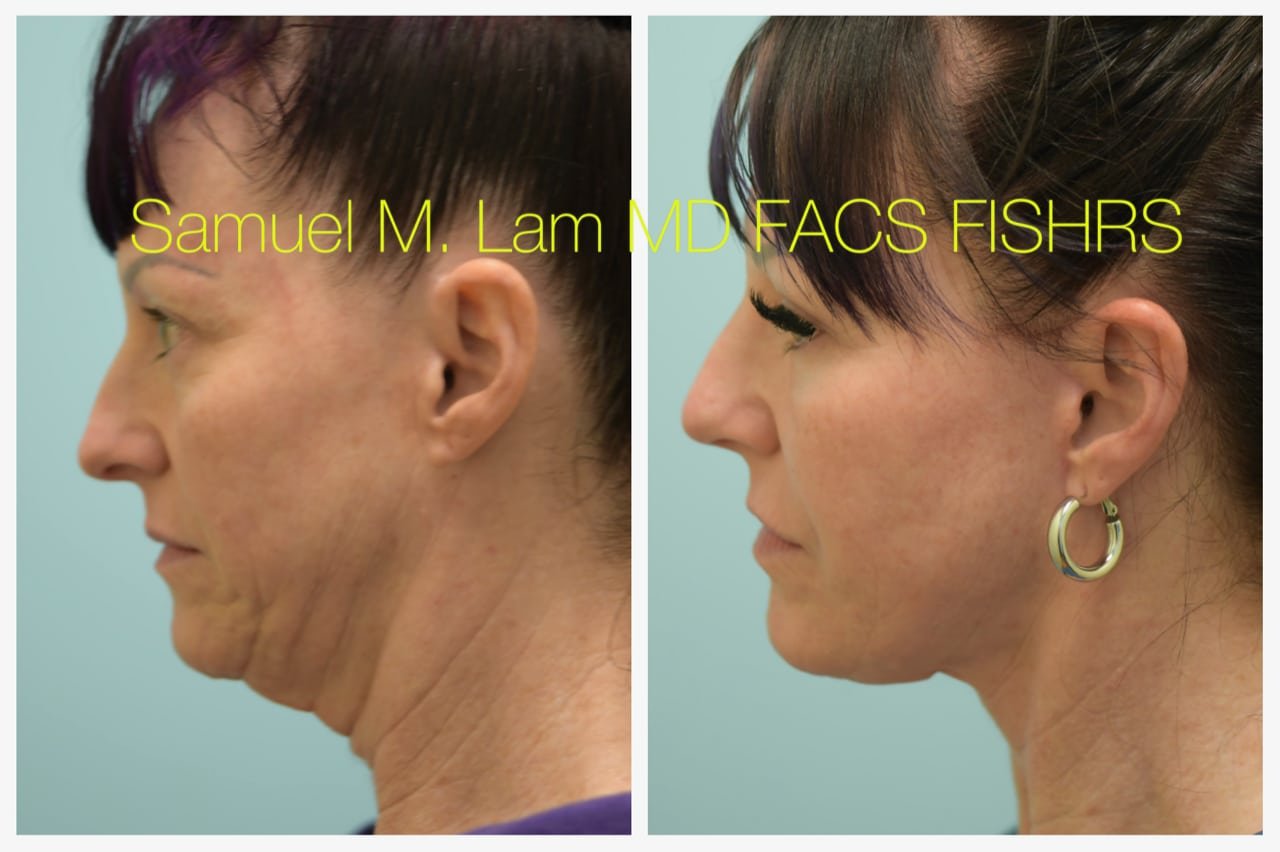 Rhinoplasty Before and After Photo by Dr. Lam in Plano TX
