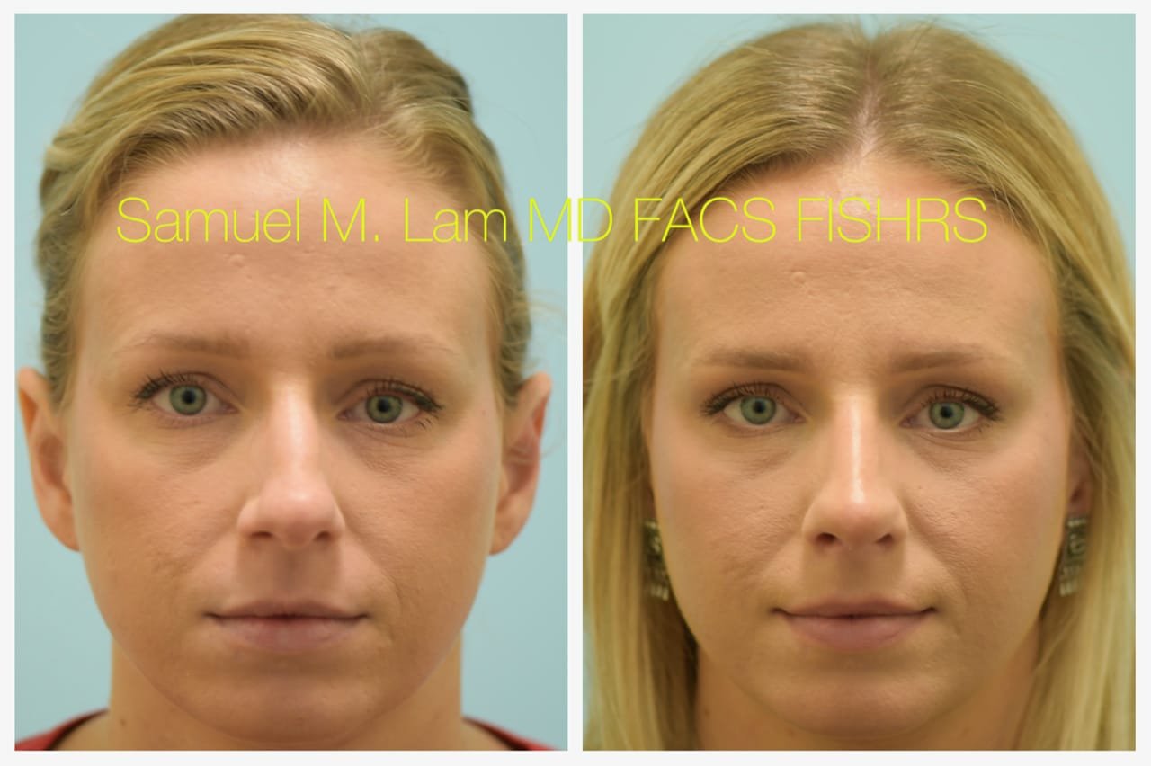 rhinoplasty-1of11-42623 Rhinoplasty Before and After Photo by Dr. Lam in Plano TX
