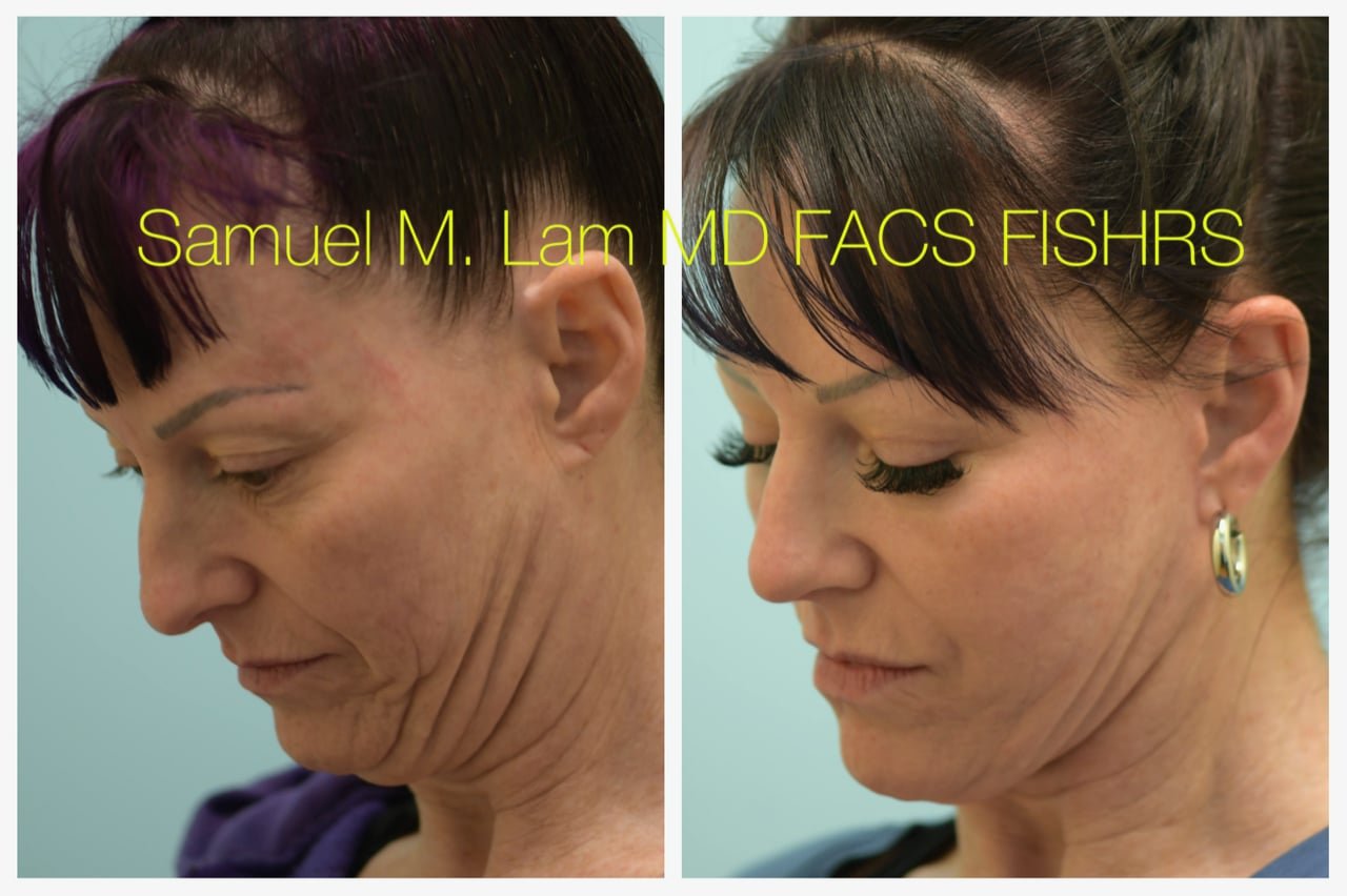 Rhinoplasty Before and After Photo by Dr. Lam in Plano TX