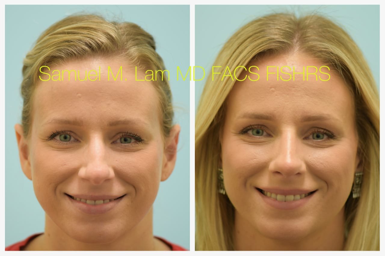 rhinoplasty-2of11-42623 Rhinoplasty Before and After Photo by Dr. Lam in Plano TX