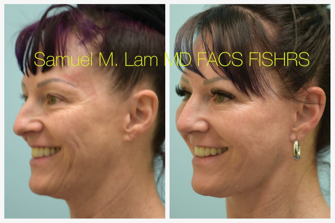 Rhinoplasty Before and After Photo by Dr. Lam in Plano TX