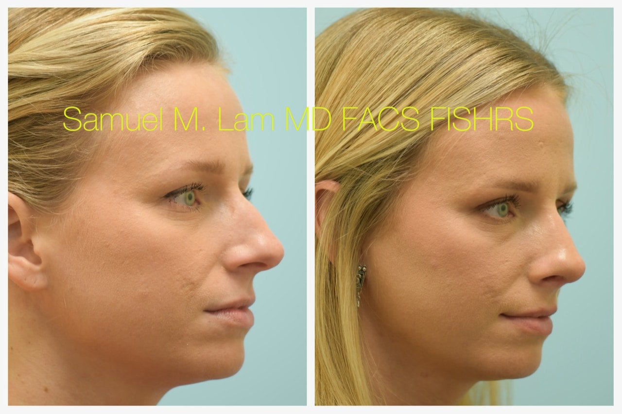 rhinoplasty-3of11-42623 Rhinoplasty Before and After Photo by Dr. Lam in Plano TX