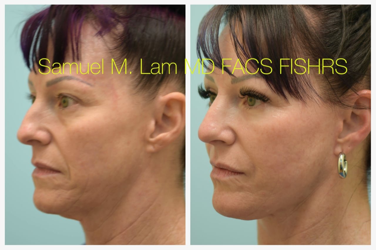 Rhinoplasty Before and After Photo by Dr. Lam in Plano TX