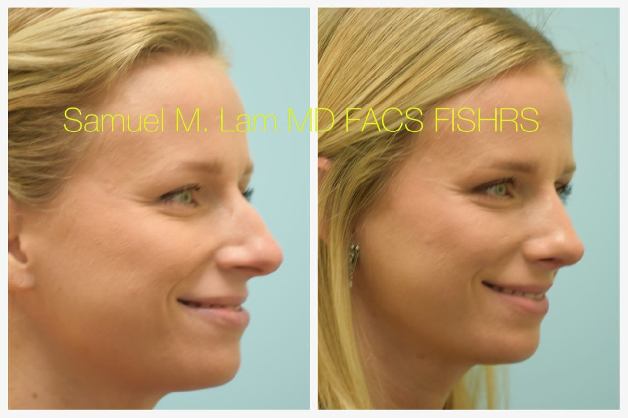 rhinoplasty-4of11-42623 Rhinoplasty Before and After Photo by Dr. Lam in Plano TX