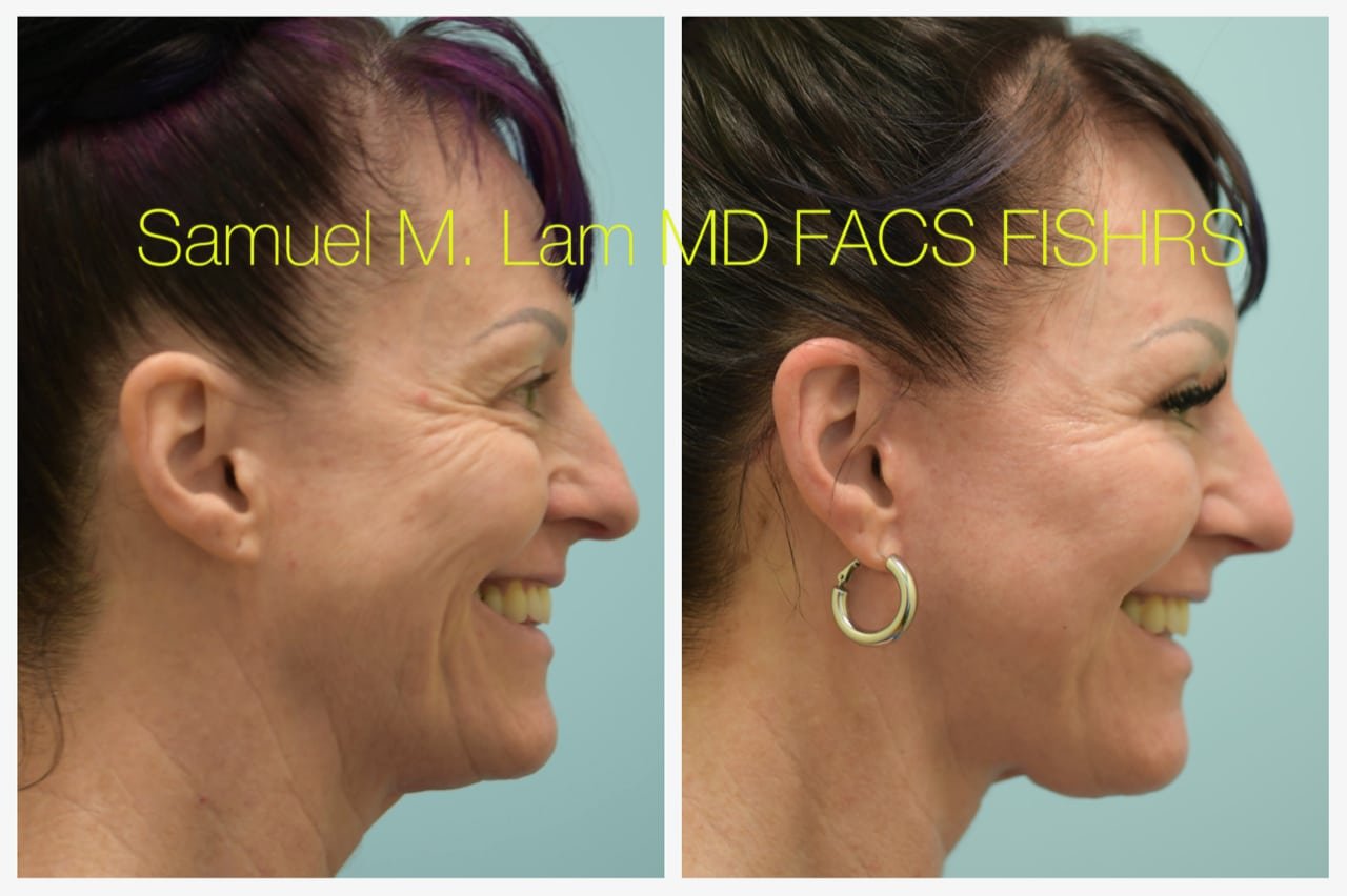 Rhinoplasty Before and After Photo by Dr. Lam in Plano TX