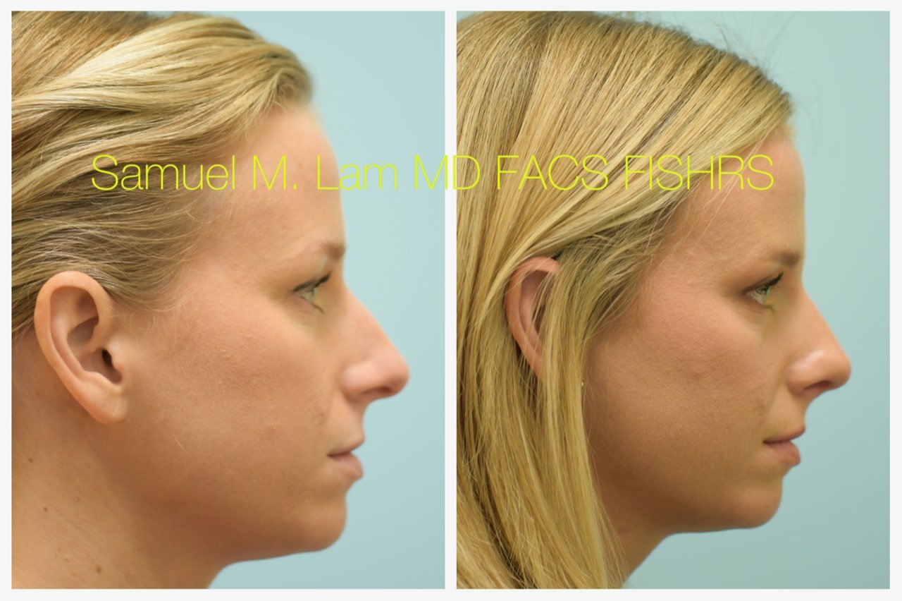 rhinoplasty-5of11-42623 Rhinoplasty Before and After Photo by Dr. Lam in Plano TX