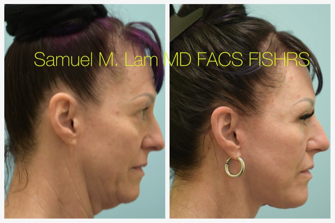 Rhinoplasty Before and After Photo by Dr. Lam in Plano TX
