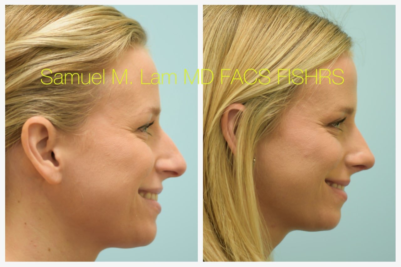 rhinoplasty-6of11-42623 Rhinoplasty Before and After Photo by Dr. Lam in Plano TX