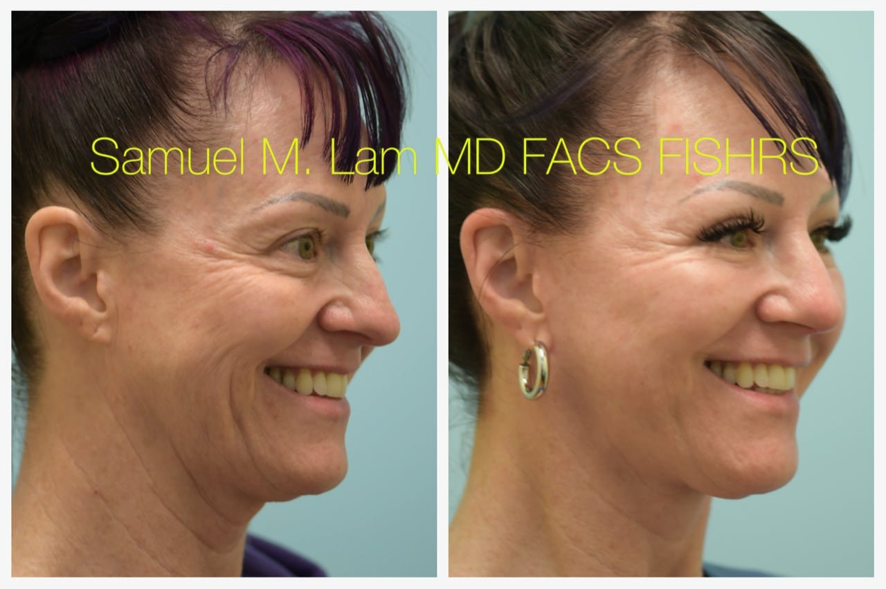 Rhinoplasty Before and After Photo by Dr. Lam in Plano TX