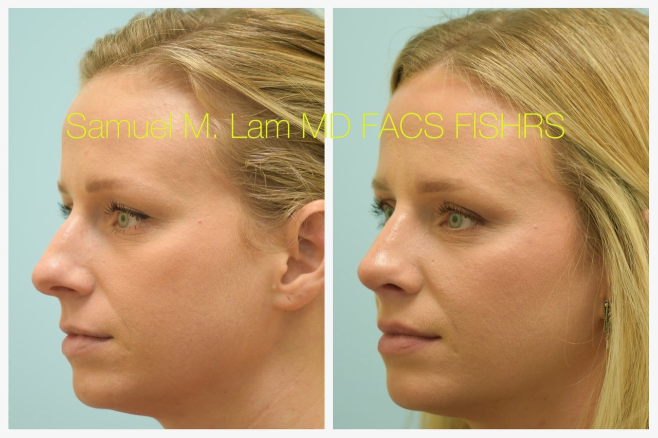 rhinoplasty-7of11-42623 Rhinoplasty Before and After Photo by Dr. Lam in Plano TX