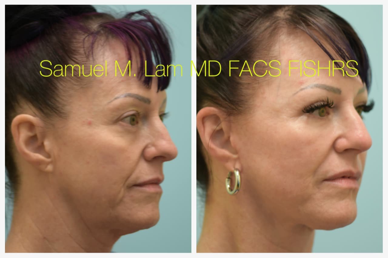 Rhinoplasty Before and After Photo by Dr. Lam in Plano TX