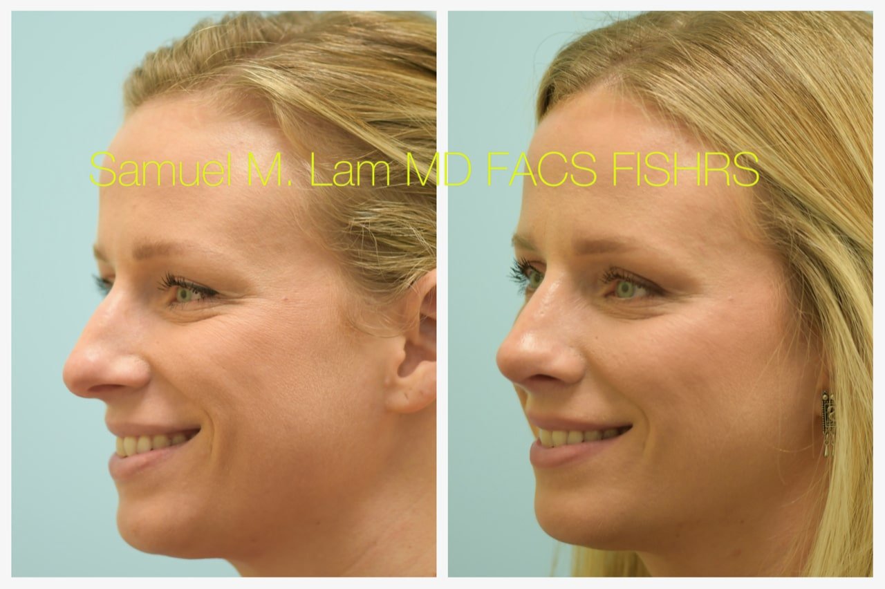 rhinoplasty-8of11-42623 Rhinoplasty Before and After Photo by Dr. Lam in Plano TX