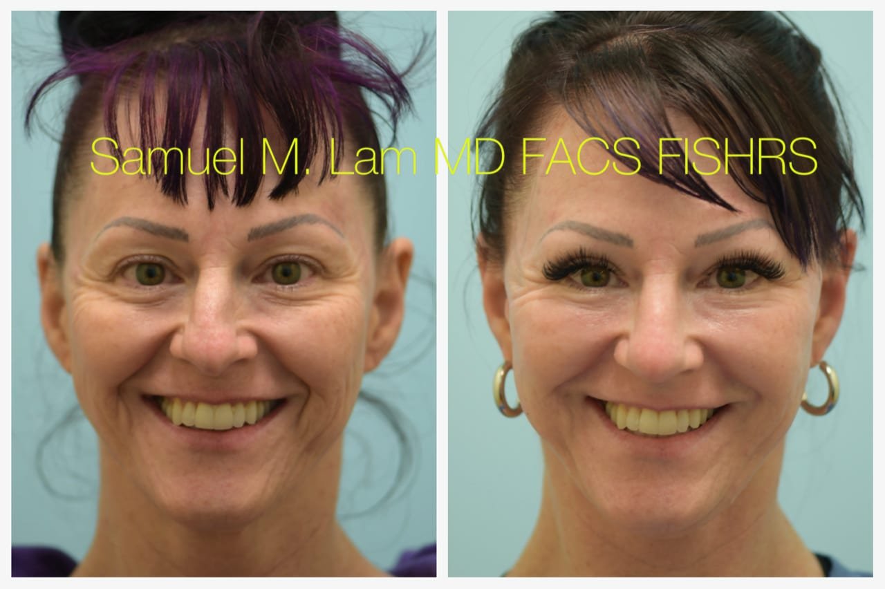 Rhinoplasty Before and After Photo by Dr. Lam in Plano TX