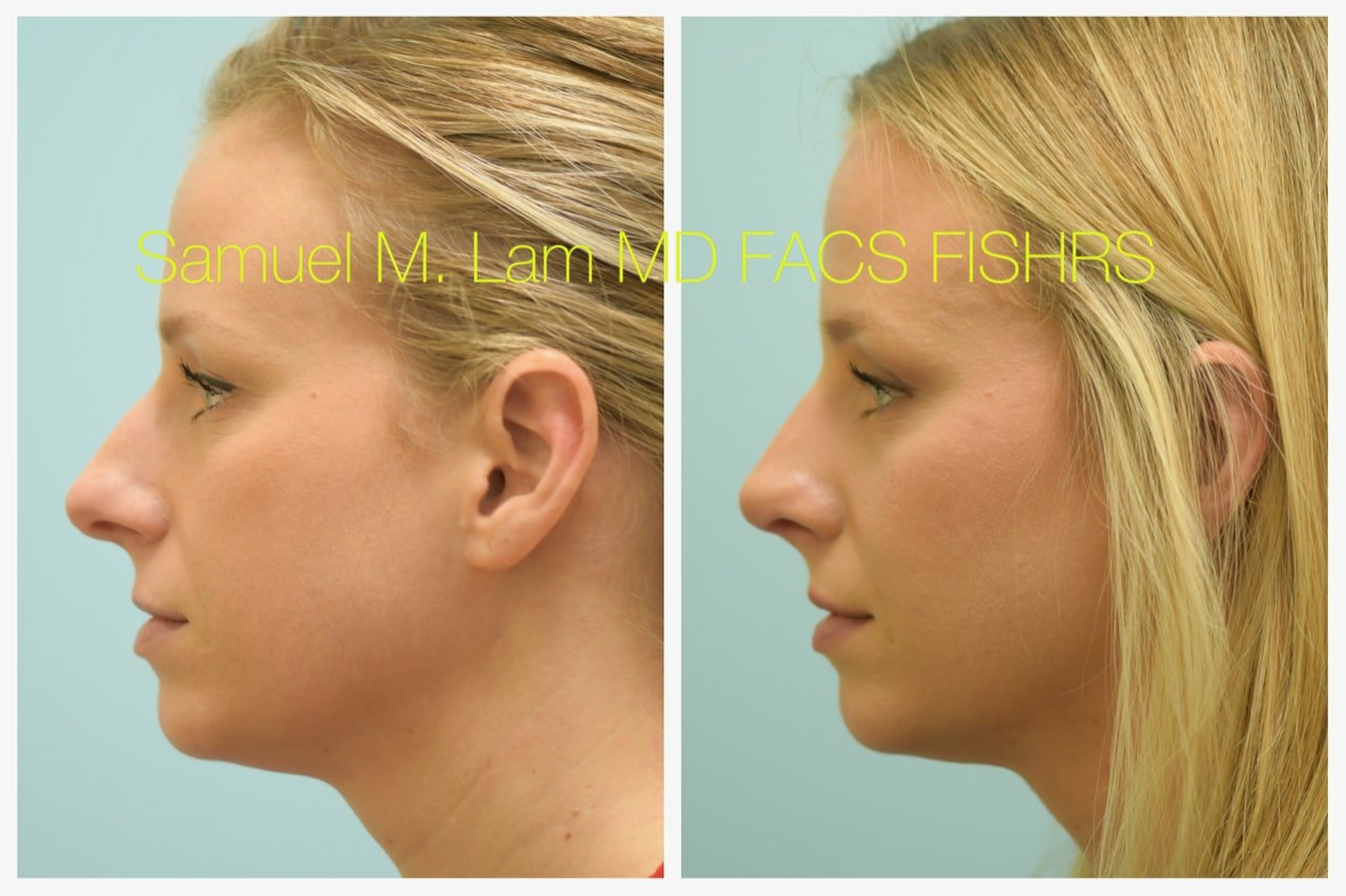 rhinoplasty-9of11-42623 Rhinoplasty Before and After Photo by Dr. Lam in Plano TX