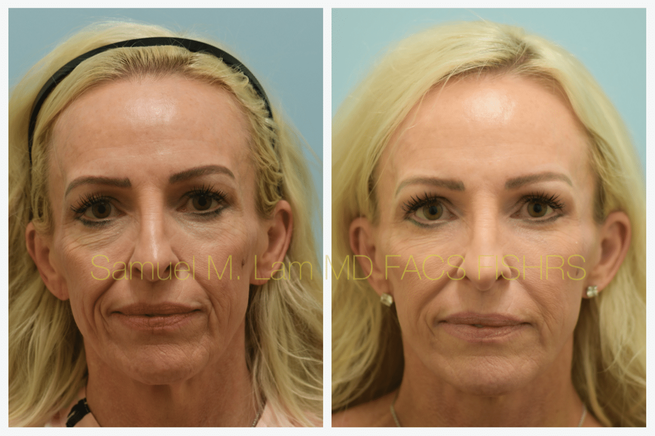 Facelift Blepharopalsty Fat Grafting Before and After Photo by Dr. Lam in Plano TX