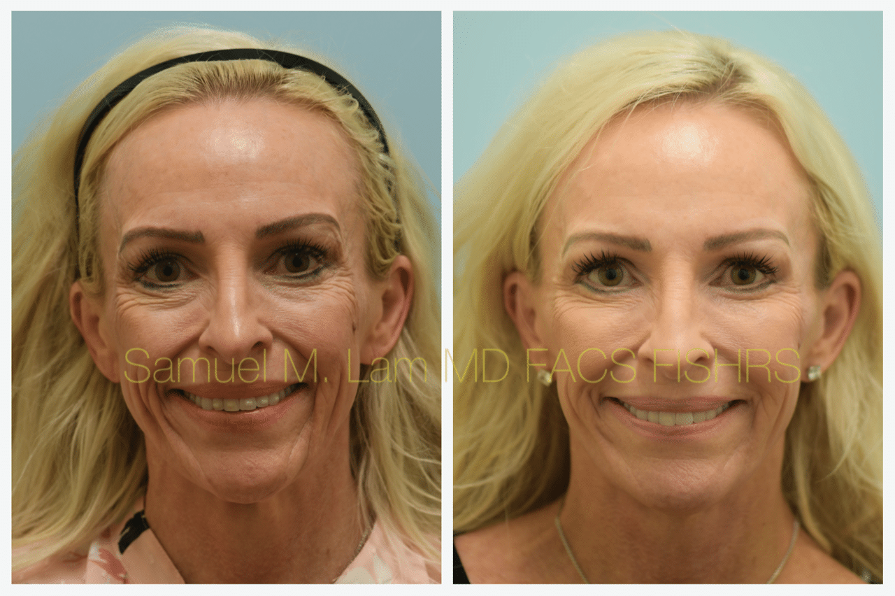 Facelift Blepharopalsty Fat Grafting Before and After Photo by Dr. Lam in Plano TX