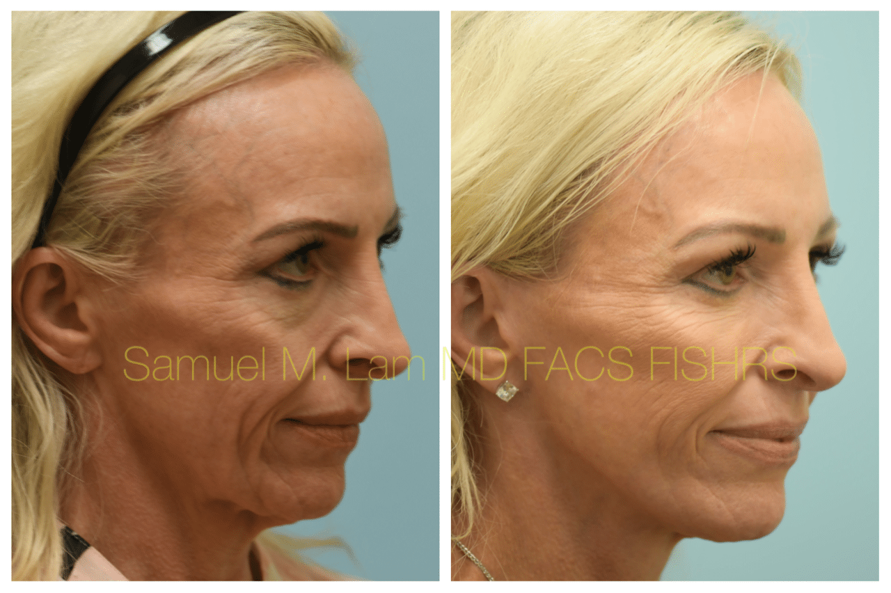 Facelift Blepharopalsty Fat Grafting Before and After Photo by Dr. Lam in Plano TX