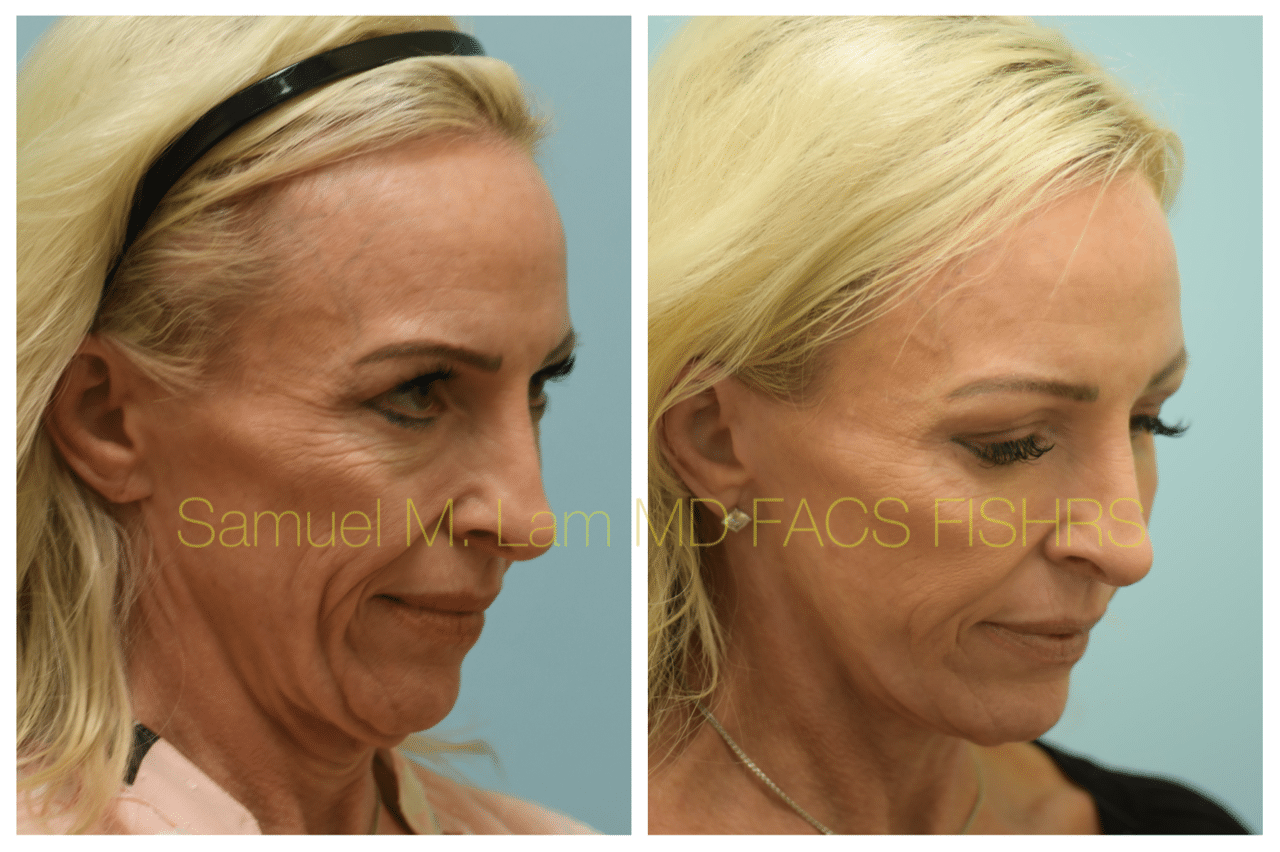 Facelift Blepharopalsty Fat Grafting Before and After Photo by Dr. Lam in Plano TX