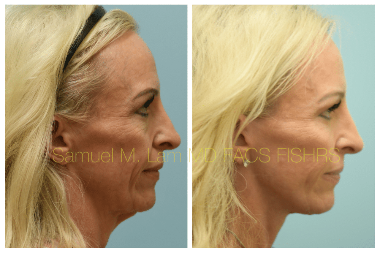 Facelift Blepharopalsty Fat Grafting Before and After Photo by Dr. Lam in Plano TX