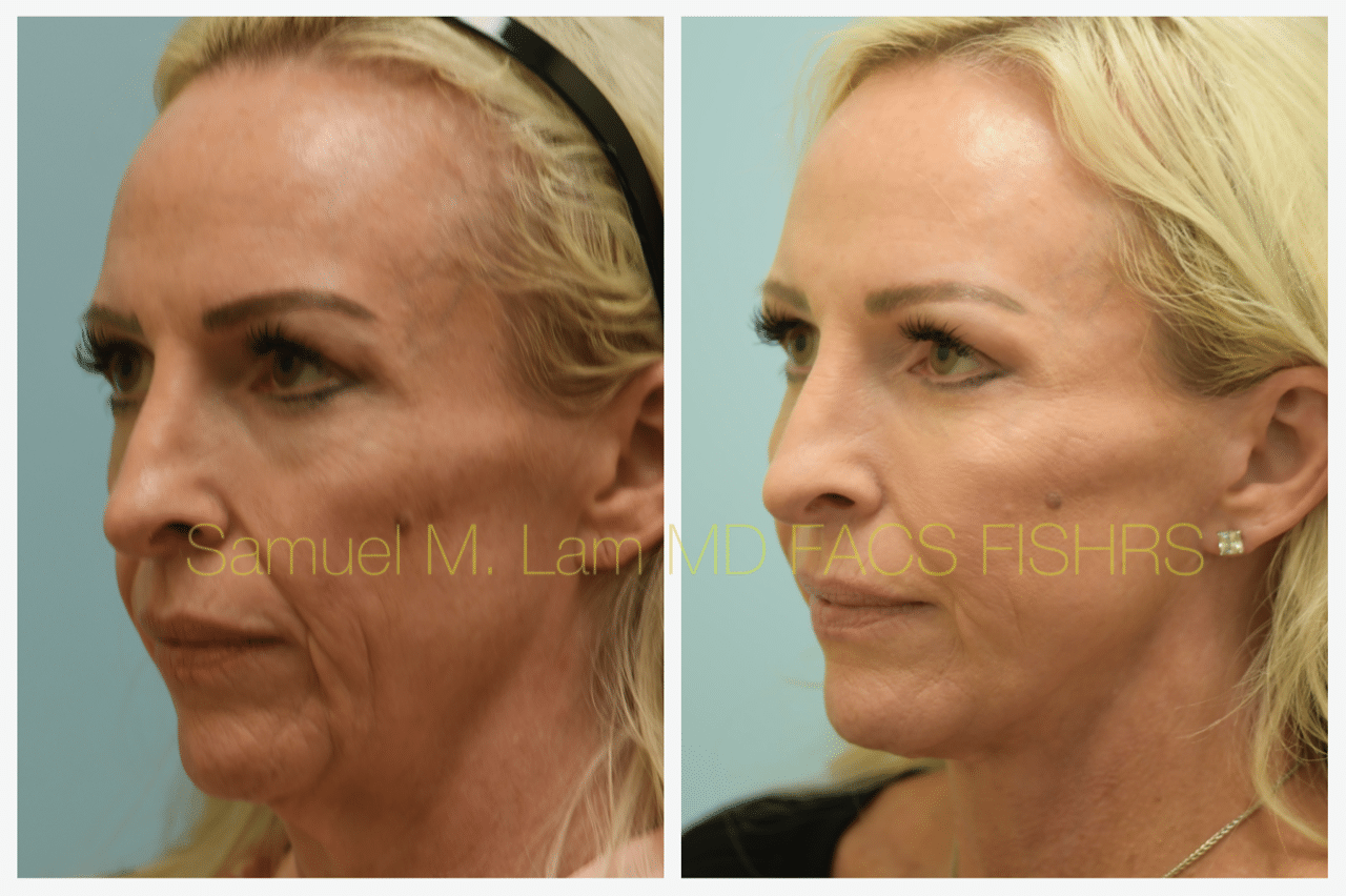 Facelift Blepharopalsty Fat Grafting Before and After Photo by Dr. Lam in Plano TX