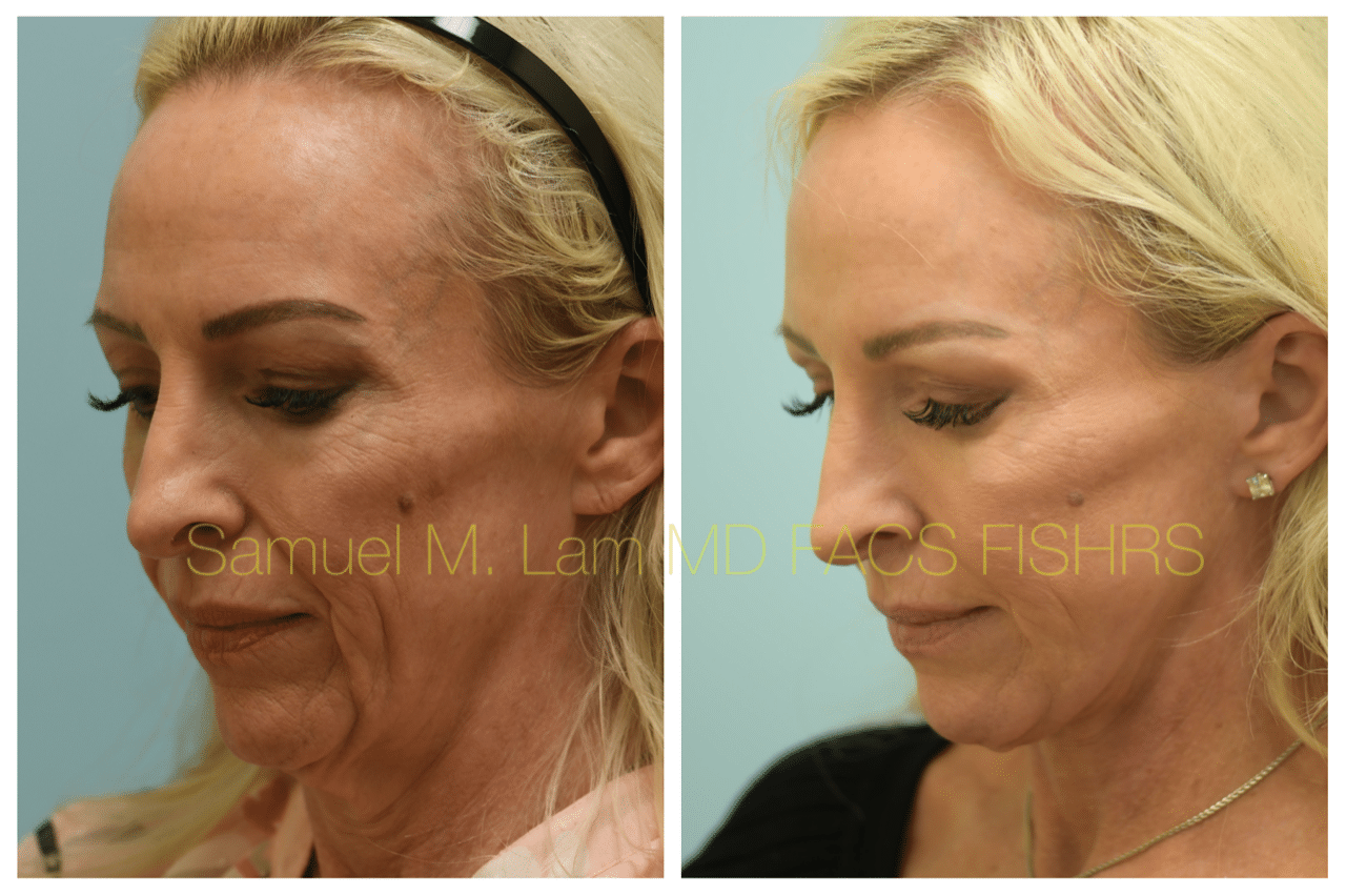 Facelift Blepharopalsty Fat Grafting Before and After Photo by Dr. Lam in Plano TX