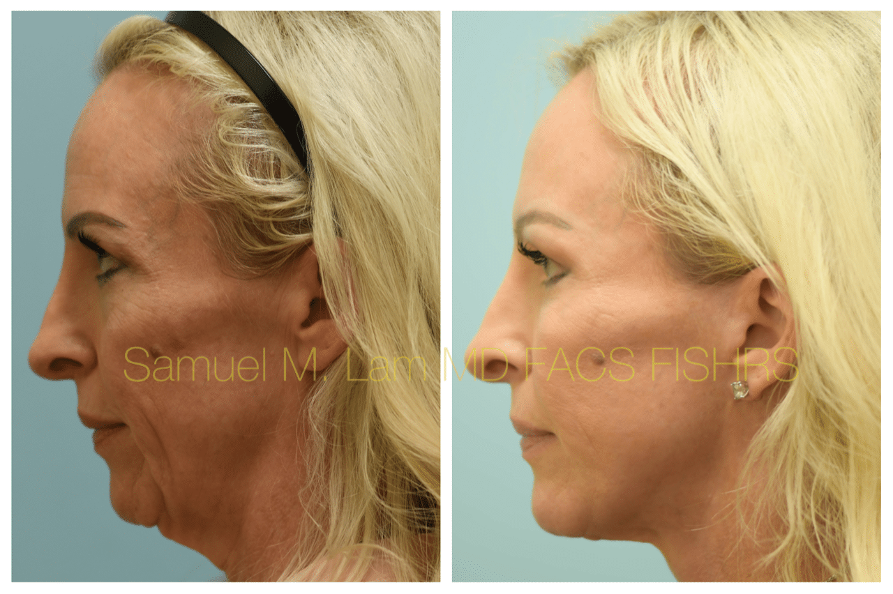 Facelift Blepharopalsty Fat Grafting Before and After Photo by Dr. Lam in Plano TX