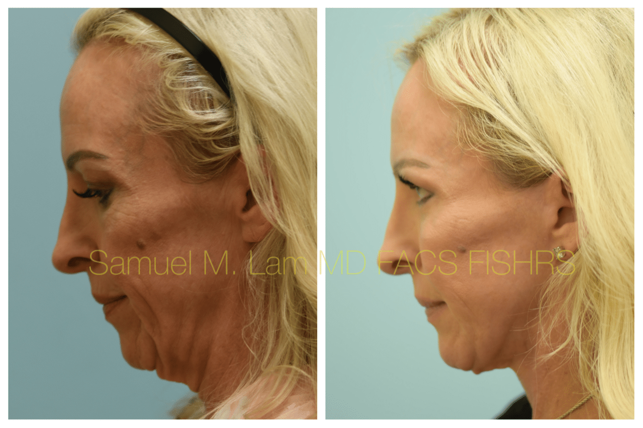 Facelift Blepharopalsty Fat Grafting Before and After Photo by Dr. Lam in Plano TX