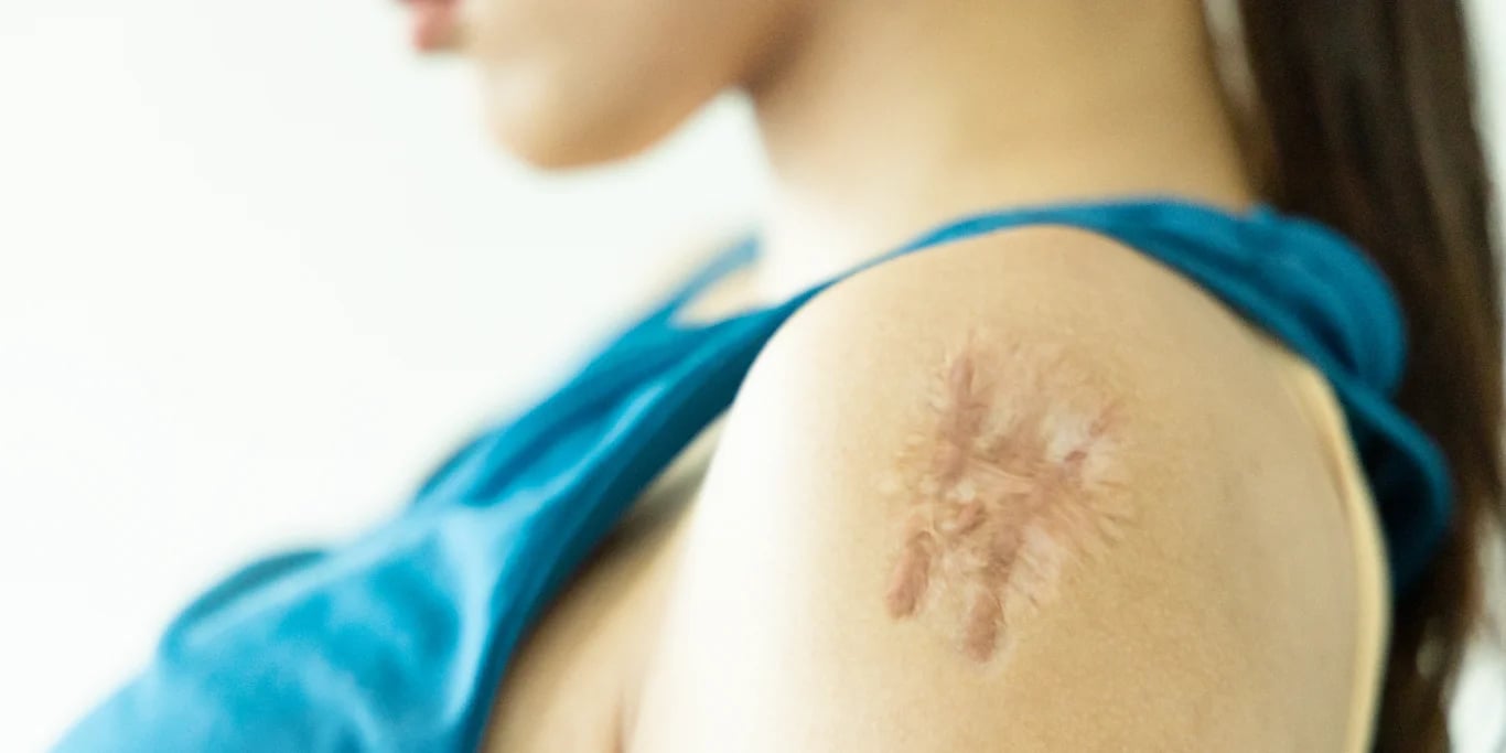 Woman having large hypertrophic scar on her left upper arm Woman having large hypertrophic scar on her left upper arm