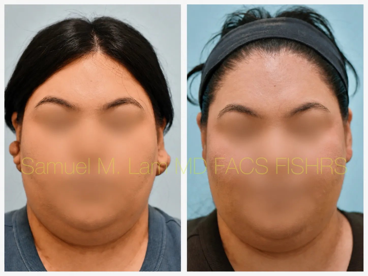 front view keloids removal before and after photo by Dr. Sam Lam front view keloids removal before and after photo by Dr. Sam Lam