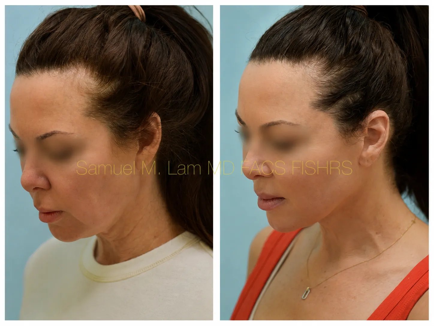 left oblique view facelift before and after photo by Dr. Sam Lam left oblique view facelift before and after photo by Dr. Sam Lam