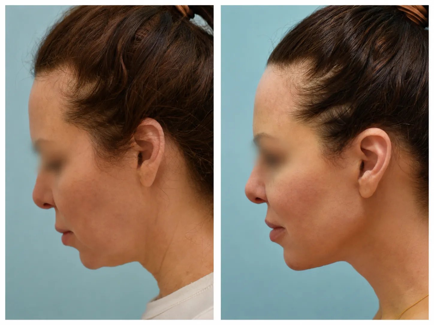 left side view facelift before and after photo by Dr. Sam Lam left side view facelift before and after photo by Dr. Sam Lam