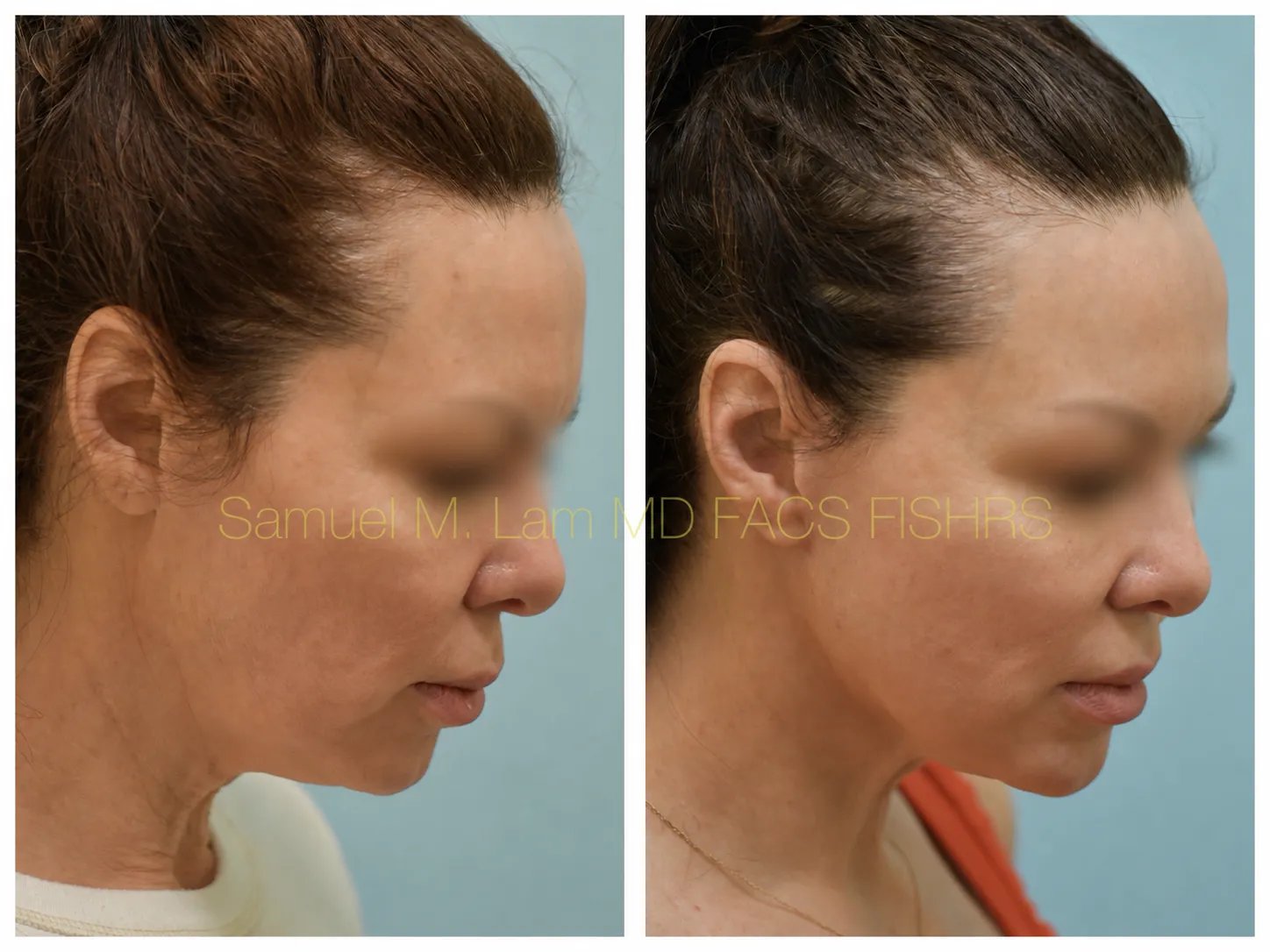 right oblique view facelift before and after photo by Dr. Sam Lam right oblique view facelift before and after photo by Dr. Sam Lam