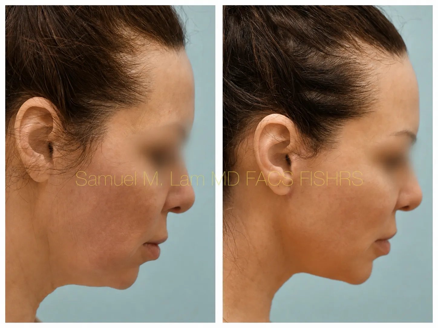 right side view facelift before and after photo by Dr. Sam Lam right side view facelift before and after photo by Dr. Sam Lam