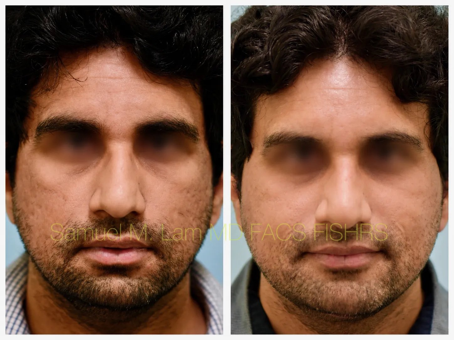 front view Acne scar correction MesoBotox before and after photo by Dr. Sam Lam front view Acne scar correction MesoBotox before and after photo by Dr. Sam Lam