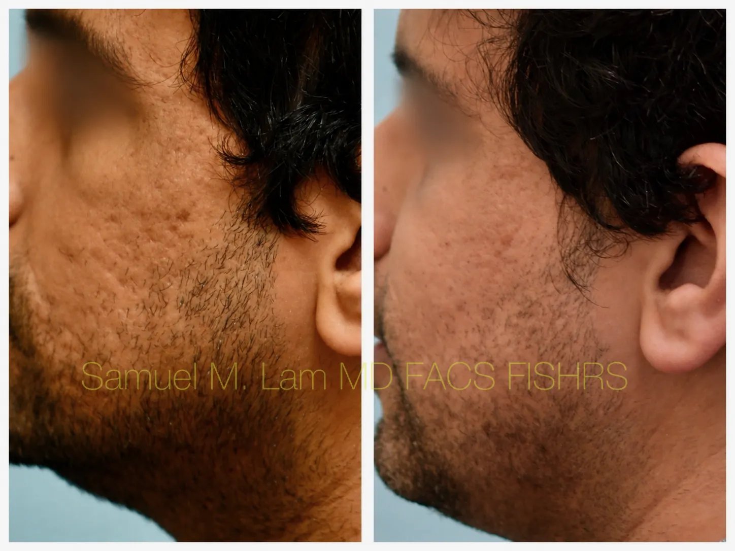 left side view Acne scar correction MesoBotox before and after photo by Dr. Sam Lam left side view Acne scar correction MesoBotox before and after photo by Dr. Sam Lam