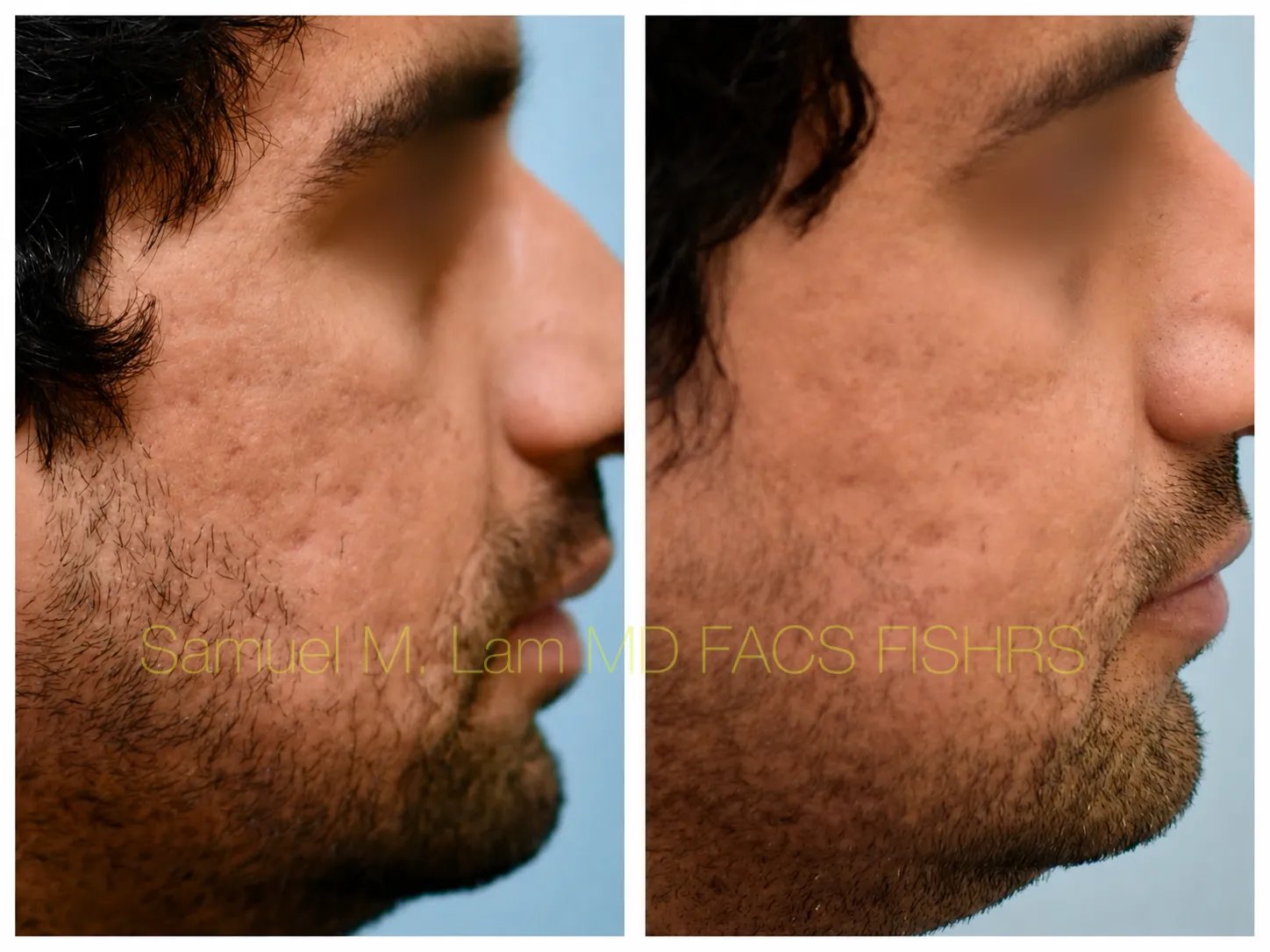 right side view Acne scar correction MesoBotox before and after photo by Dr. Sam Lam right side view Acne scar correction MesoBotox before and after photo by Dr. Sam Lam