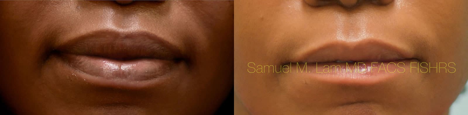 Lip Reduction Before and After Photo by Dr. Lam in Plano TX